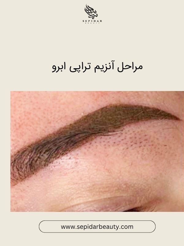 آنزیم تراپی ابرو
