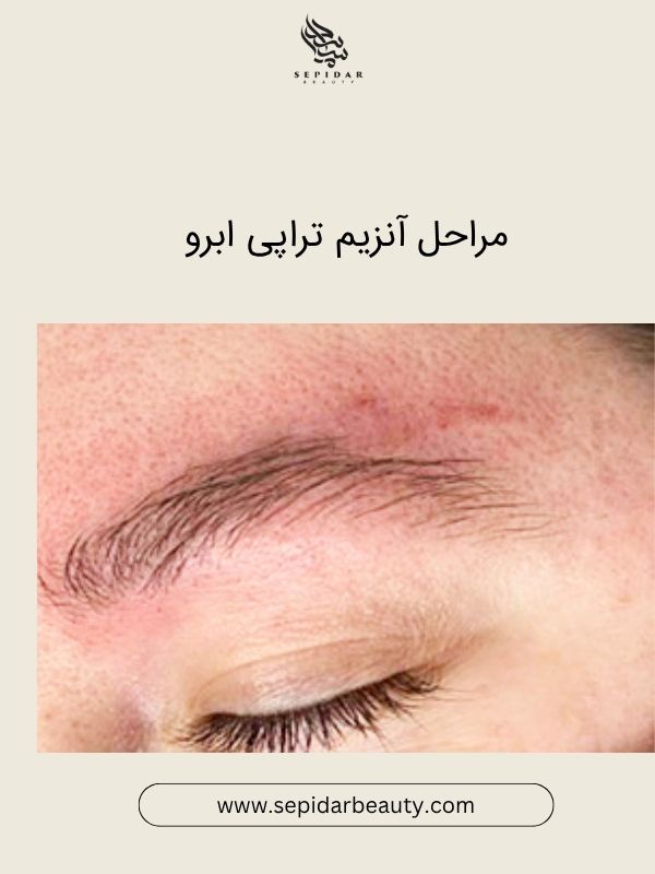 آنزیم تراپی ارو