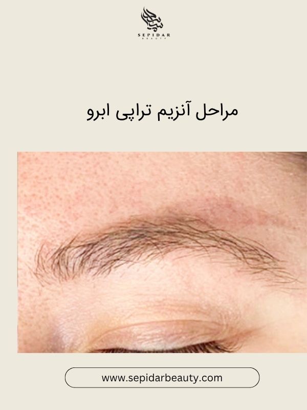 آنزیم تراپی ابرو